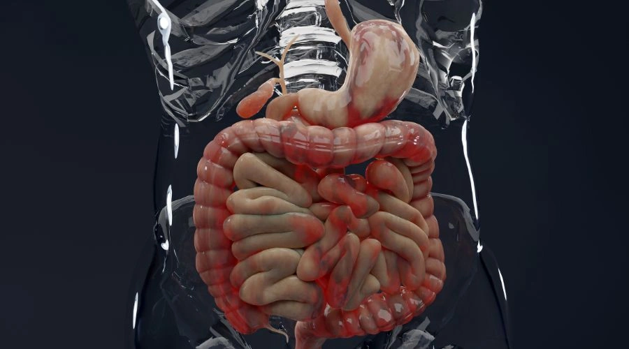 Medical illustration showing inflamed intestines affected by Crohn’s disease and alcohol use
